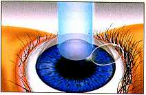 How LASIK works. Corneal cap lifted.