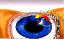 How LASIK works. Corneal cap closed.