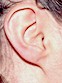 Paula's Ear - Look Ma, no earlobe!