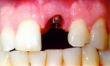 implant