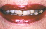 pretreatment a