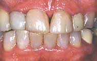 pretreatment b