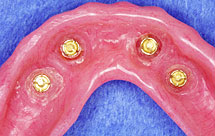 Bar connecting implants