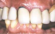 pretreatment b